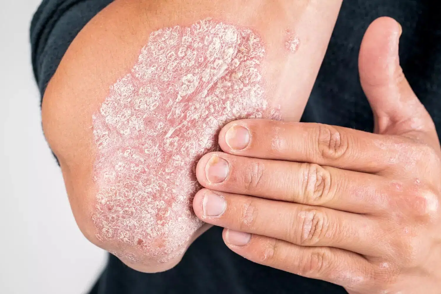 psoriasis