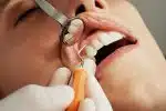 trous dans les dents